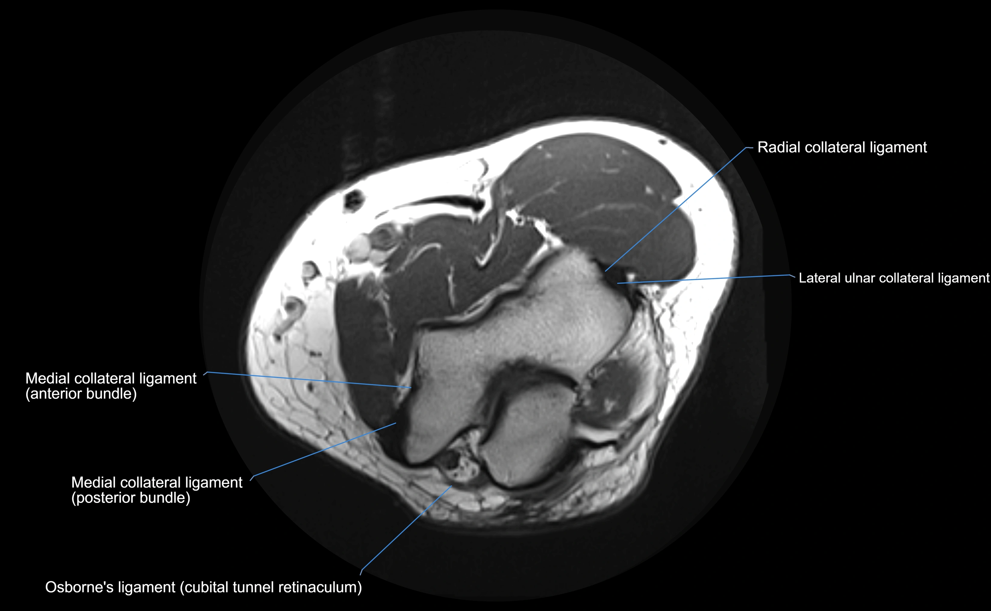 MRI elbow ligaments axial cross sectional anatomy 3T  radiology  image-img-00001-00012.webp